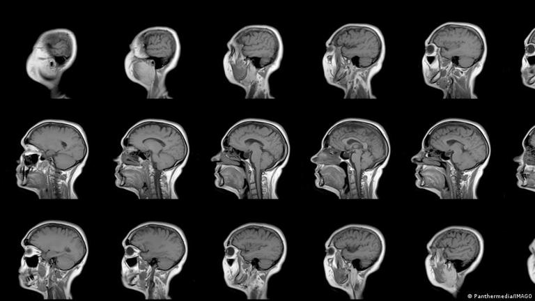 Escáneres cerebrales identifican seis tipos distintos de depresión y ansiedad