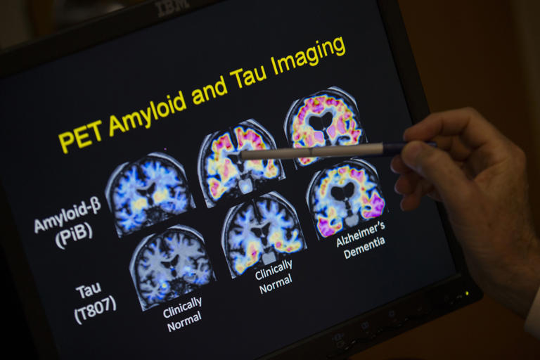 Los análisis de sangre para detectar el Alzheimer podrían esta a la vuelta de la esquina